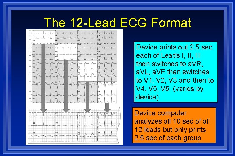 The 12 -Lead ECG Format Device prints out 2. 5 sec each of Leads