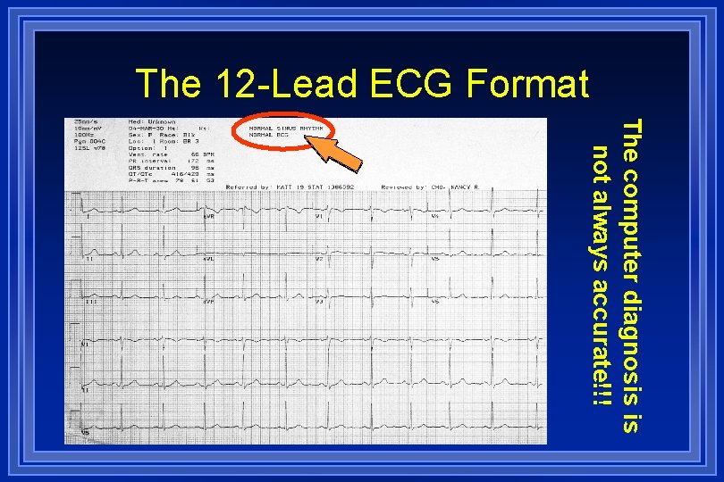 The 12 -Lead ECG Format The computer diagnosis is not always accurate!!! 
