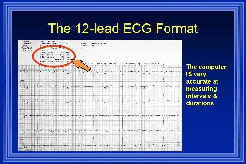 The 12 -lead ECG Format The computer IS very accurate at measuring intervals &