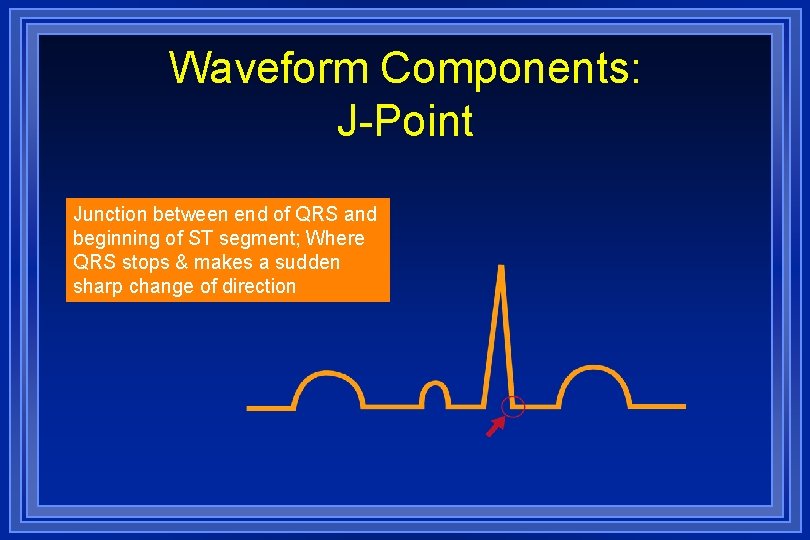 Waveform Components: J-Point Junction between end of QRS and beginning of ST segment; Where