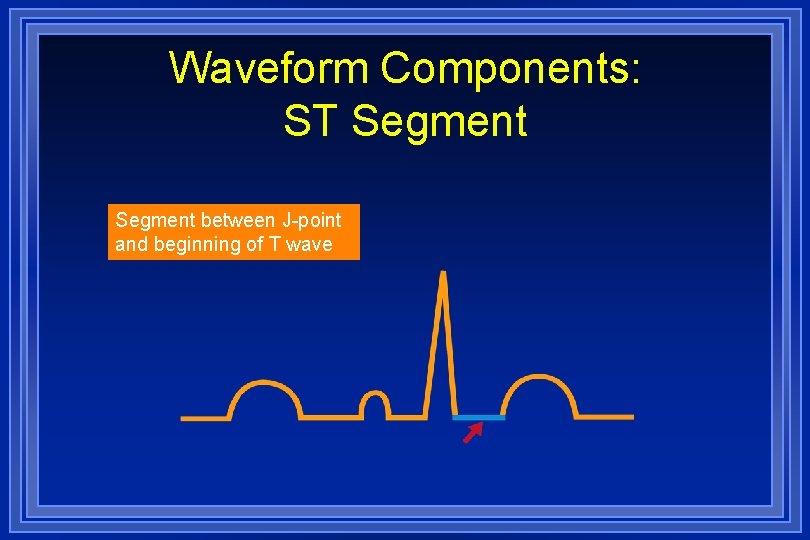 Waveform Components: ST Segment between J-point and beginning of T wave 