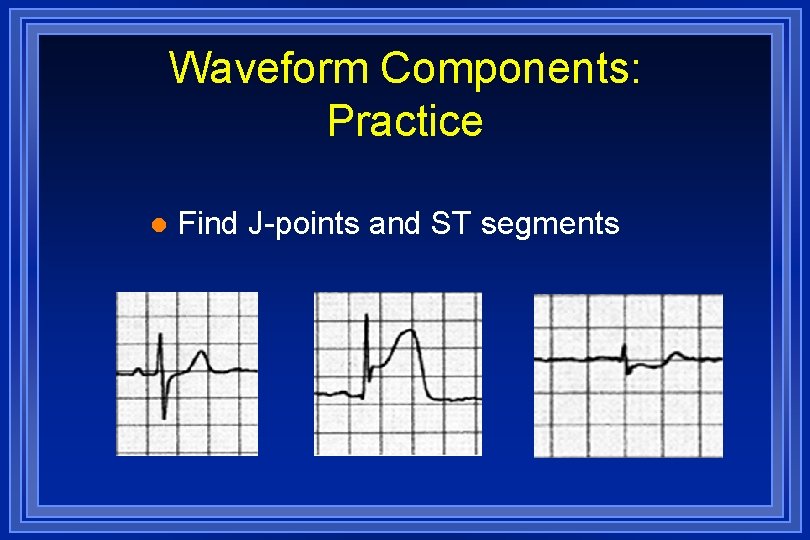 Waveform Components: Practice l Find J-points and ST segments 