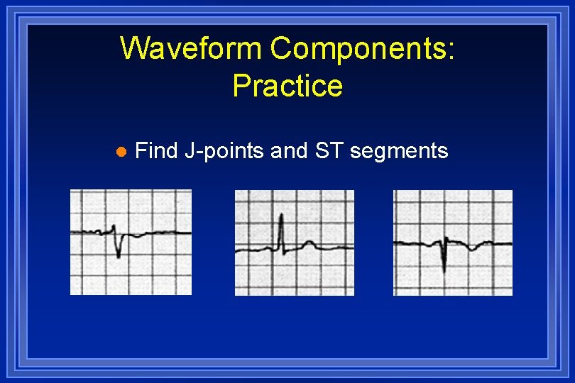 Waveform Components: Practice l Find J-points and ST segments 
