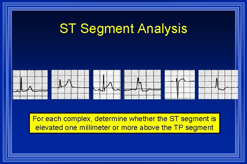 ST Segment Analysis For each complex, determine whether the ST segment is elevated one