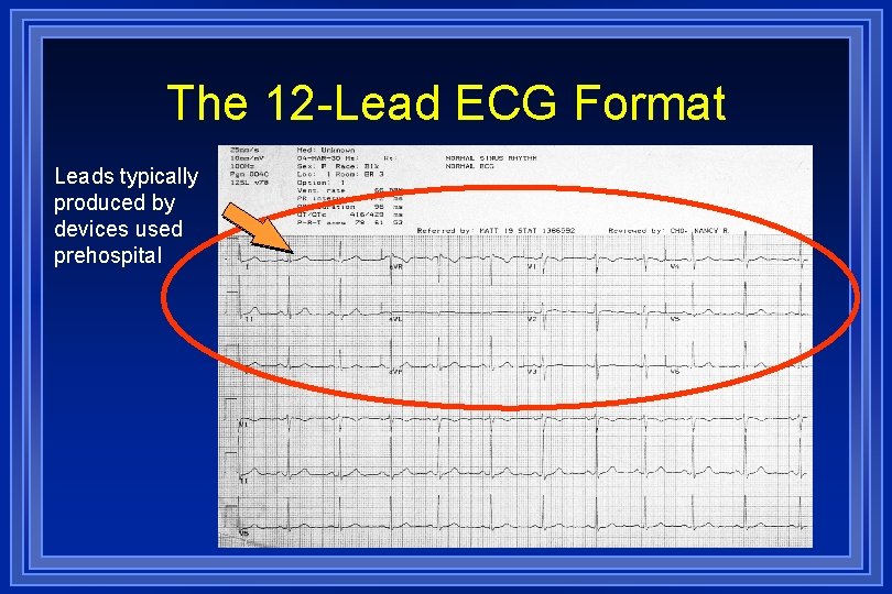 The 12 -Lead ECG Format Leads typically produced by devices used prehospital 