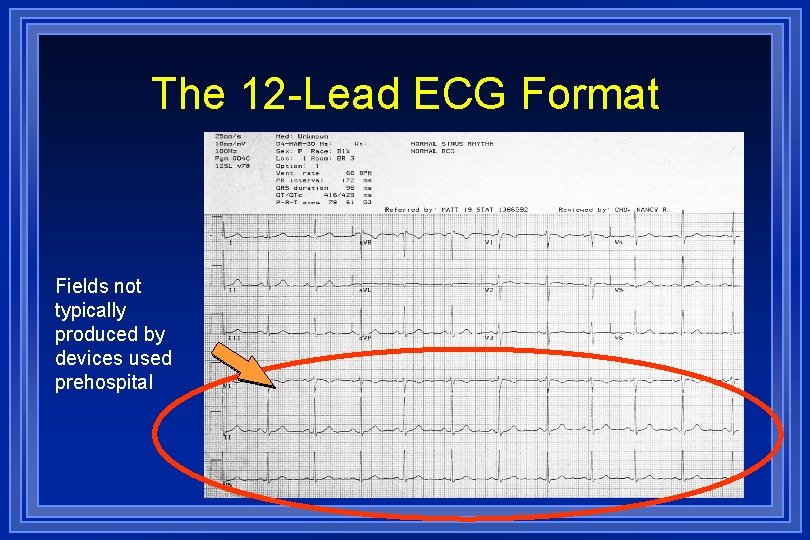 The 12 -Lead ECG Format Fields not typically produced by devices used prehospital 