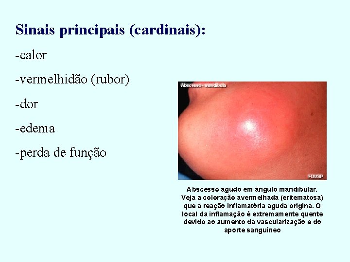 Sinais principais (cardinais): -calor -vermelhidão (rubor) -dor -edema -perda de função Abscesso agudo em Sinais principais (cardinais): -calor -vermelhidão (rubor) -dor -edema -perda de função Abscesso agudo em