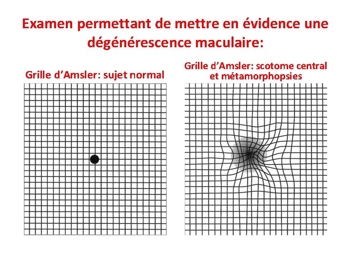 Examen permettant de mettre en évidence une dégénérescence maculaire: Grille d’Amsler: sujet normal Grille