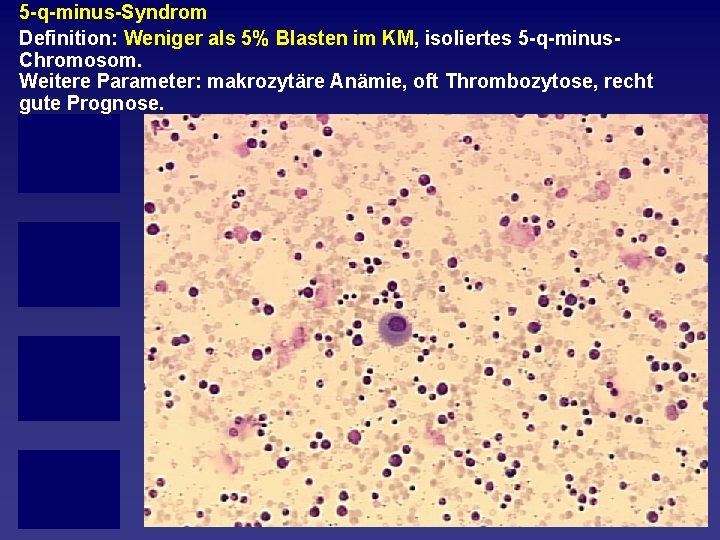 5 q minus Syndrom Definition: Weniger als 5% Blasten im KM, isoliertes 5 q
