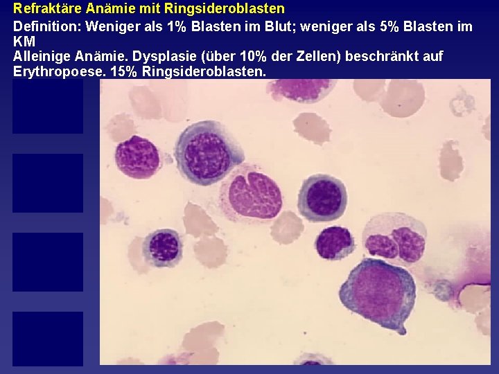 Refraktäre Anämie mit Ringsideroblasten Definition: Weniger als 1% Blasten im Blut; weniger als 5%