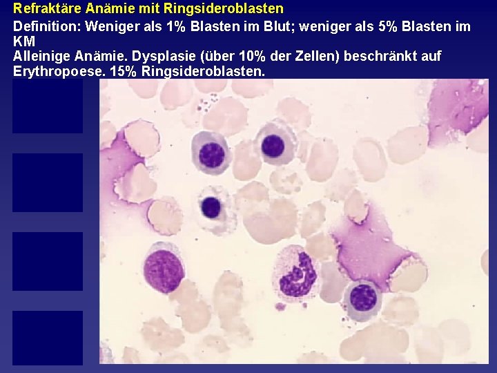 Refraktäre Anämie mit Ringsideroblasten Definition: Weniger als 1% Blasten im Blut; weniger als 5%