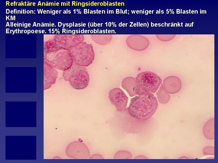 Refraktäre Anämie mit Ringsideroblasten Definition: Weniger als 1% Blasten im Blut; weniger als 5%