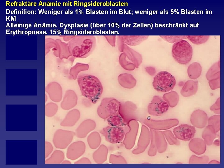 Refraktäre Anämie mit Ringsideroblasten Definition: Weniger als 1% Blasten im Blut; weniger als 5%