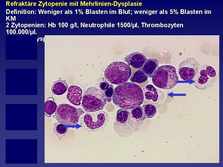 Refraktäre Zytopenie mit Mehrlinien Dysplasie Definition: Weniger als 1% Blasten im Blut; weniger als