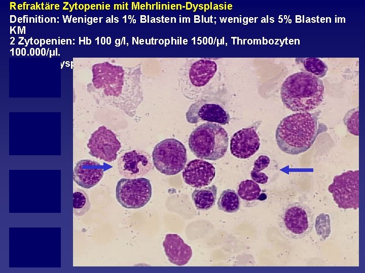 Refraktäre Zytopenie mit Mehrlinien Dysplasie Definition: Weniger als 1% Blasten im Blut; weniger als