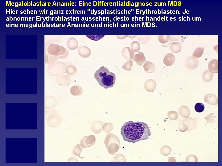 Megaloblastäre Anämie: Eine Differentialdiagnose zum MDS Hier sehen wir ganz extrem "dysplastische" Erythroblasten. Je