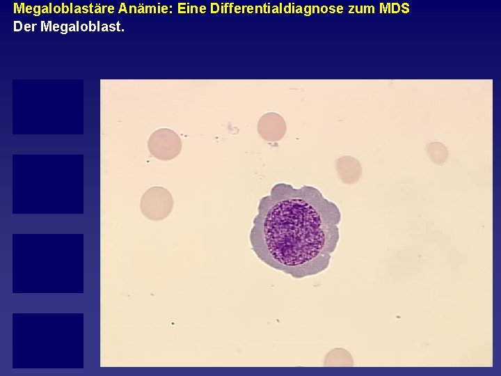 Megaloblastäre Anämie: Eine Differentialdiagnose zum MDS Der Megaloblast. 