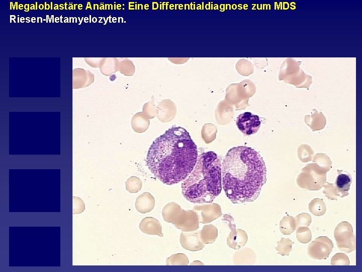 Megaloblastäre Anämie: Eine Differentialdiagnose zum MDS Riesen Metamyelozyten. 