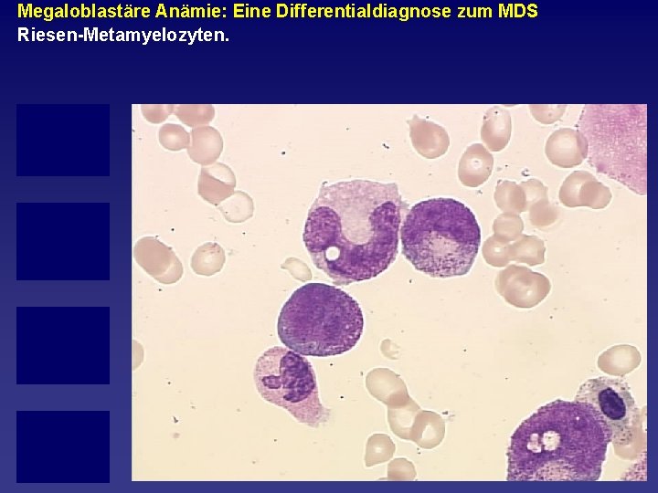 Megaloblastäre Anämie: Eine Differentialdiagnose zum MDS Riesen Metamyelozyten. 