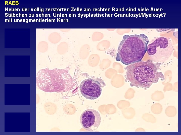 RAEB Neben der völlig zerstörten Zelle am rechten Rand sind viele Auer Stäbchen zu