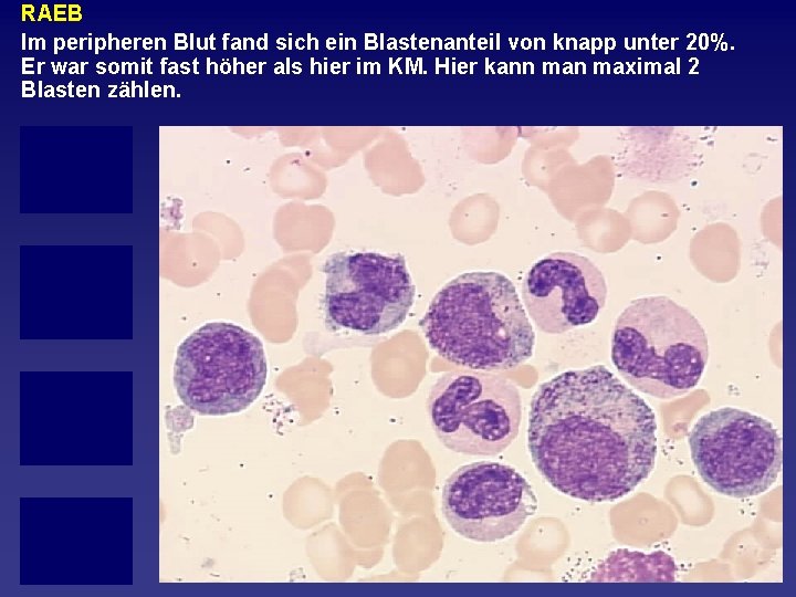 RAEB Im peripheren Blut fand sich ein Blastenanteil von knapp unter 20%. Er war