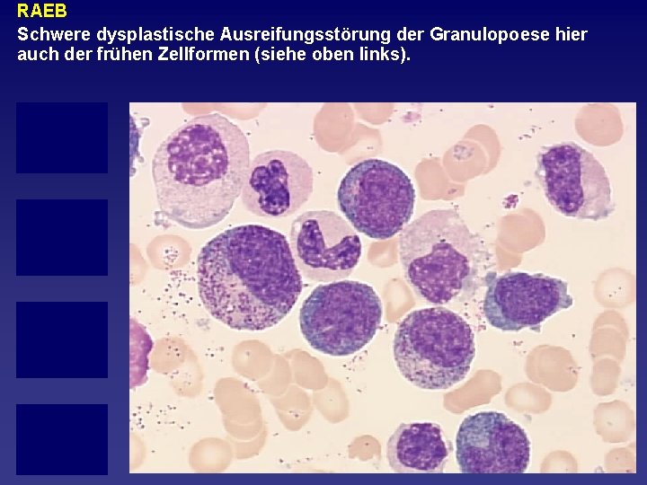 RAEB Schwere dysplastische Ausreifungsstörung der Granulopoese hier auch der frühen Zellformen (siehe oben links).