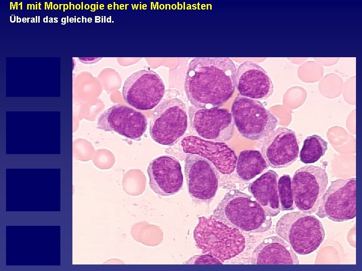 M 1 mit Morphologie eher wie Monoblasten Überall das gleiche Bild. 