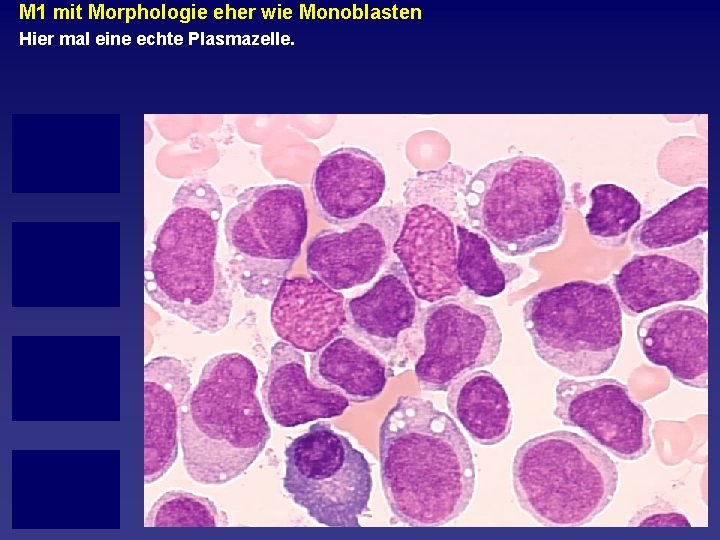 M 1 mit Morphologie eher wie Monoblasten Hier mal eine echte Plasmazelle. 