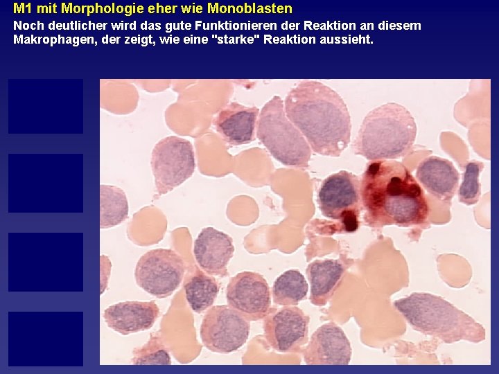 M 1 mit Morphologie eher wie Monoblasten Noch deutlicher wird das gute Funktionieren der