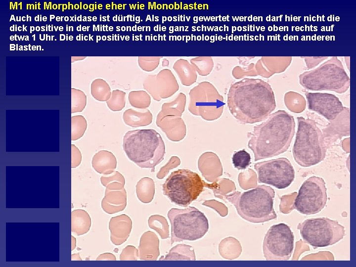 M 1 mit Morphologie eher wie Monoblasten Auch die Peroxidase ist dürftig. Als positiv