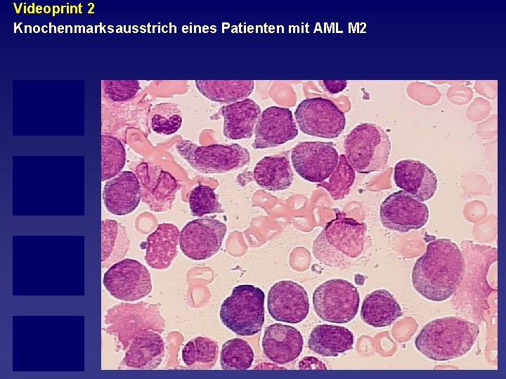 Videoprint 2 Knochenmarksausstrich eines Patienten mit AML M 2 