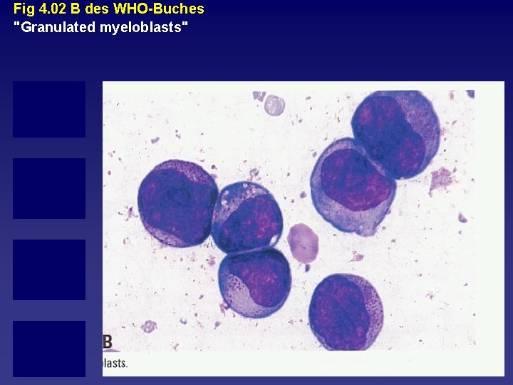 Fig 4. 02 B des WHO Buches "Granulated myeloblasts" 