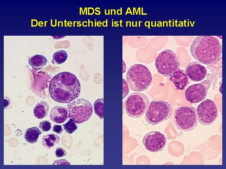 MDS und AML Der Unterschied ist nur quantitativ 