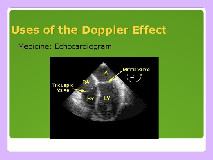 Uses of the Doppler Effect Medicine: Echocardiogram Uses of the Doppler Effect Medicine: Echocardiogram