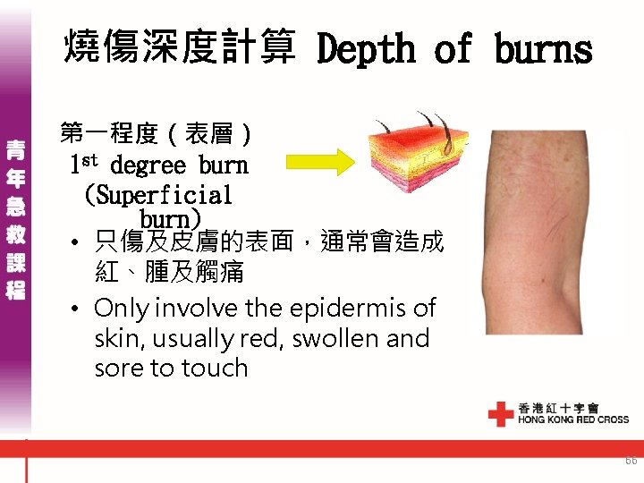 燒傷深度計算 Depth of burns 第一程度（表層） 1 st degree burn (Superficial burn) • 只傷及皮膚的表面，通常會造成 紅、腫及觸痛