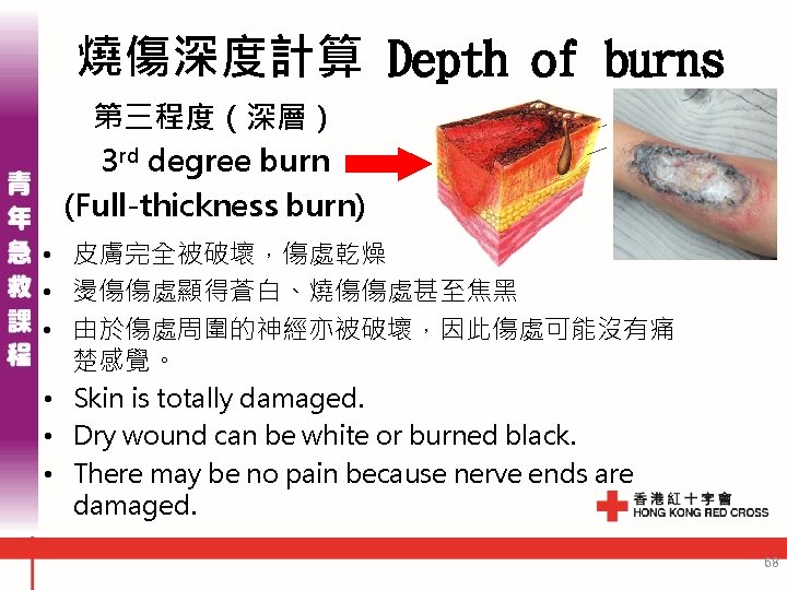 燒傷深度計算 Depth of burns 第三程度（深層） 3 rd degree burn (Full-thickness burn) • 皮膚完全被破壞，傷處乾燥 •