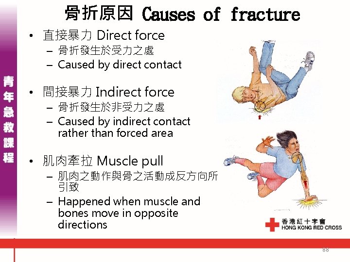 骨折原因 Causes of fracture • 直接暴力 Direct force – 骨折發生於受力之處 – Caused by direct