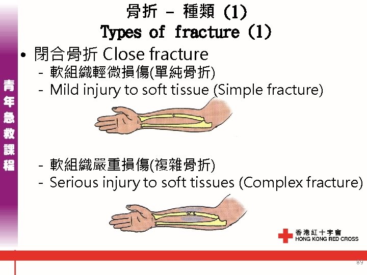 骨折 - 種類 (1) Types of fracture (1) • 閉合骨折 Close fracture - 軟組織輕微損傷(單純骨折) 骨折 - 種類 (1) Types of fracture (1) • 閉合骨折 Close fracture - 軟組織輕微損傷(單純骨折)