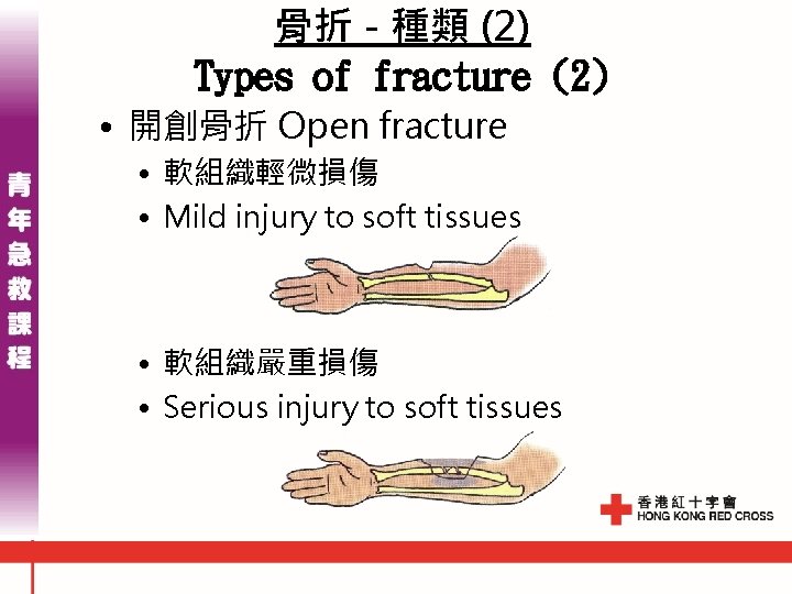 骨折 - 種類 (2) Types of fracture (2) • 開創骨折 Open fracture • 軟組織輕微損傷