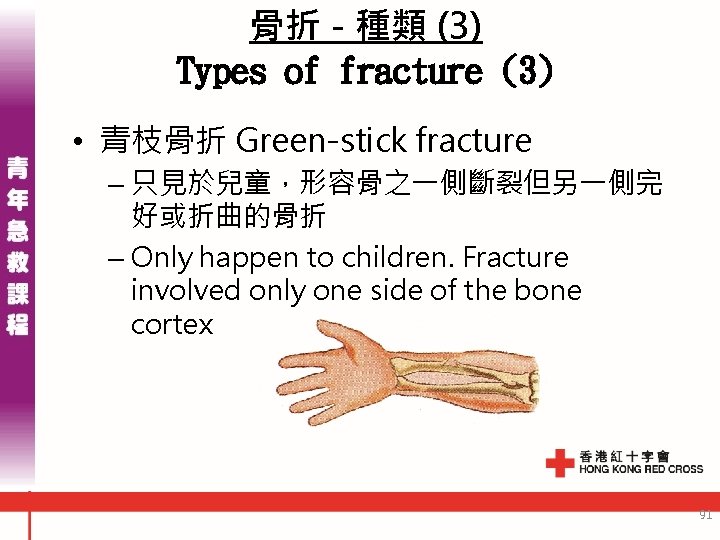 骨折 - 種類 (3) Types of fracture (3) • 青枝骨折 Green-stick fracture – 只見於兒童，形容骨之一側斷裂但另一側完