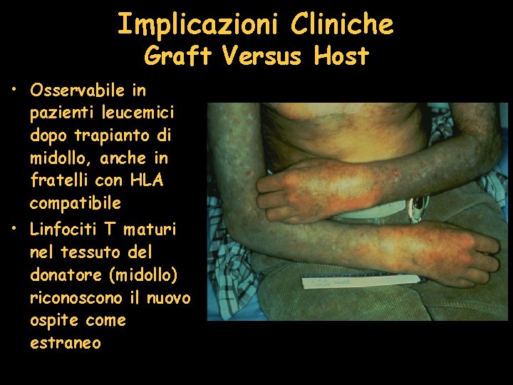 Implicazioni Cliniche Graft Versus Host • Osservabile in pazienti leucemici dopo trapianto di midollo,