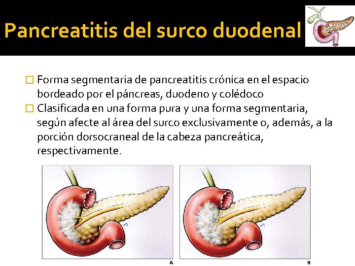 Pancreatitis del surco duodenal � Forma segmentaria de pancreatitis crónica en el espacio bordeado Pancreatitis del surco duodenal � Forma segmentaria de pancreatitis crónica en el espacio bordeado