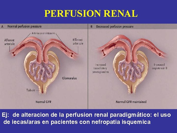 PERFUSION RENAL Ej: de alteracion de la perfusion renal paradigmático: el uso de iecas/aras