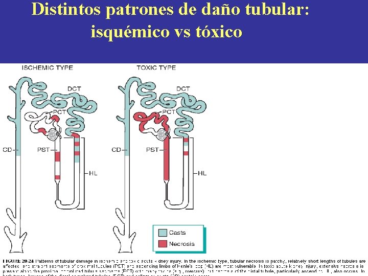 Distintos patrones de daño tubular: isquémico vs tóxico 