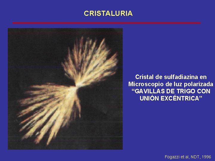 CRISTALURIA Cristal de sulfadiazina en Microscopio de luz polarizada “GAVILLAS DE TRIGO CON UNIÓN