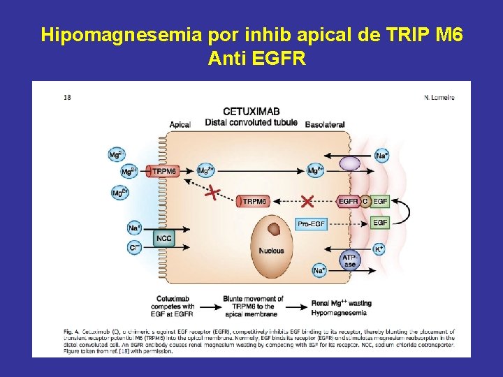 Hipomagnesemia por inhib apical de TRIP M 6 Anti EGFR 