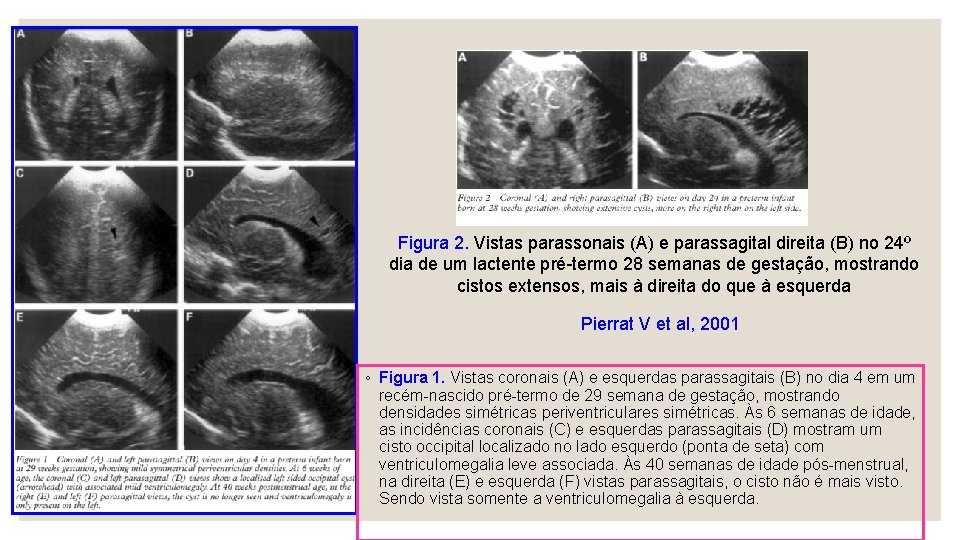 Figura 2. Vistas parassonais (A) e parassagital direita (B) no 24º dia de um