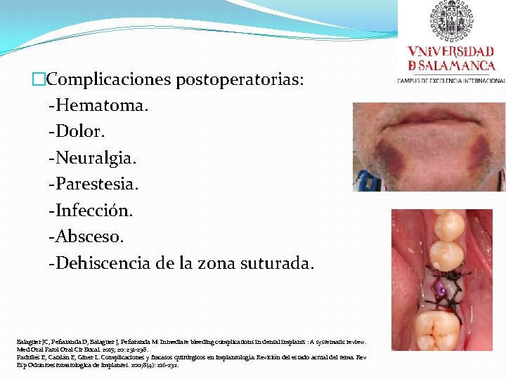 �Complicaciones postoperatorias: -Hematoma. -Dolor. -Neuralgia. -Parestesia. -Infección. -Absceso. -Dehiscencia de la zona suturada. Balaguer