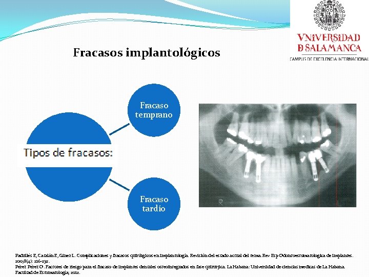 Fracasos implantológicos Fracaso temprano Fracaso tardío Padullés E, Catalán E, Giner L. Complicaciones y