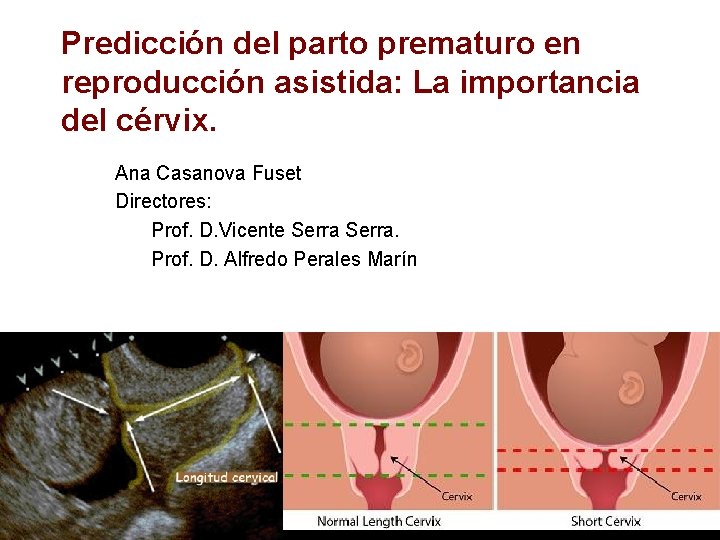 Predicción del parto prematuro en reproducción asistida: La importancia del cérvix. Ana Casanova Fuset